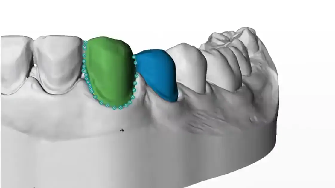 Margins traced on a scanned dental model in CAD software