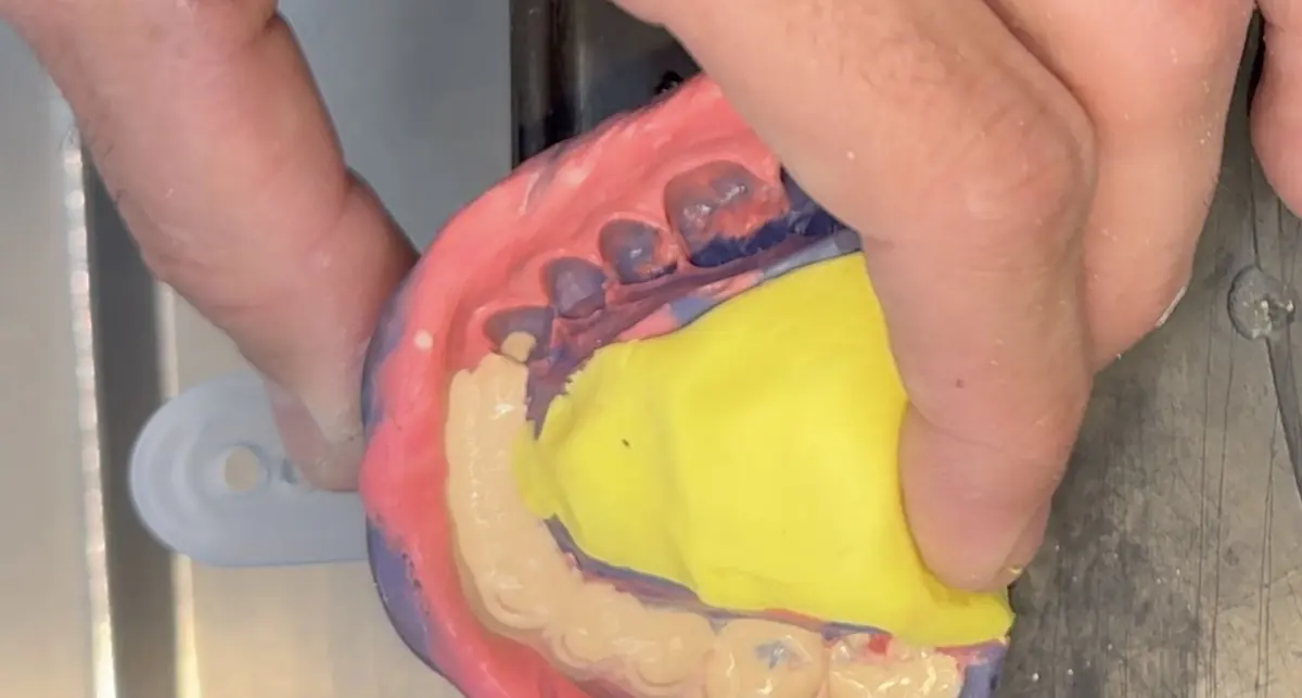 Stone poured into an impression on the vibrator